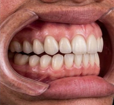 Mesma paciente com a prótese dentária flexível instalada, com arcada completa
