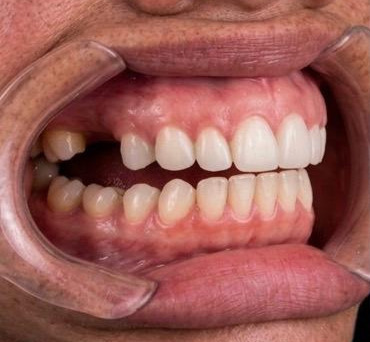 Boca da paciente sem a prótese, com ausência de dentes posteriores
